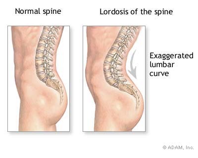 Thoracic spine exercises affect lumbar spine postural defects